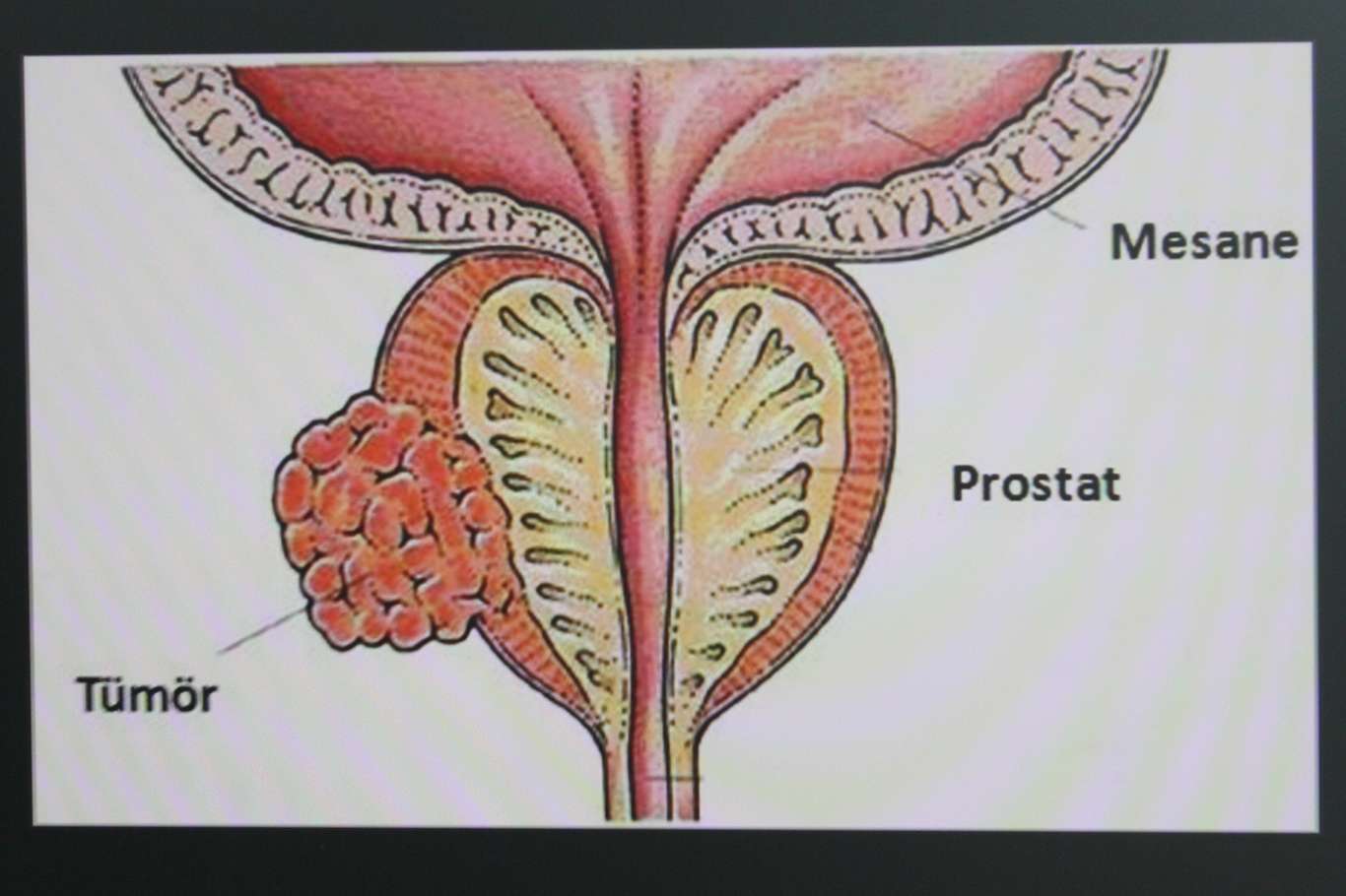 Prostat kanseri nedir, sebepleri nelerdir? Prostat kanseri nedir, sebepleri nelerdir?
